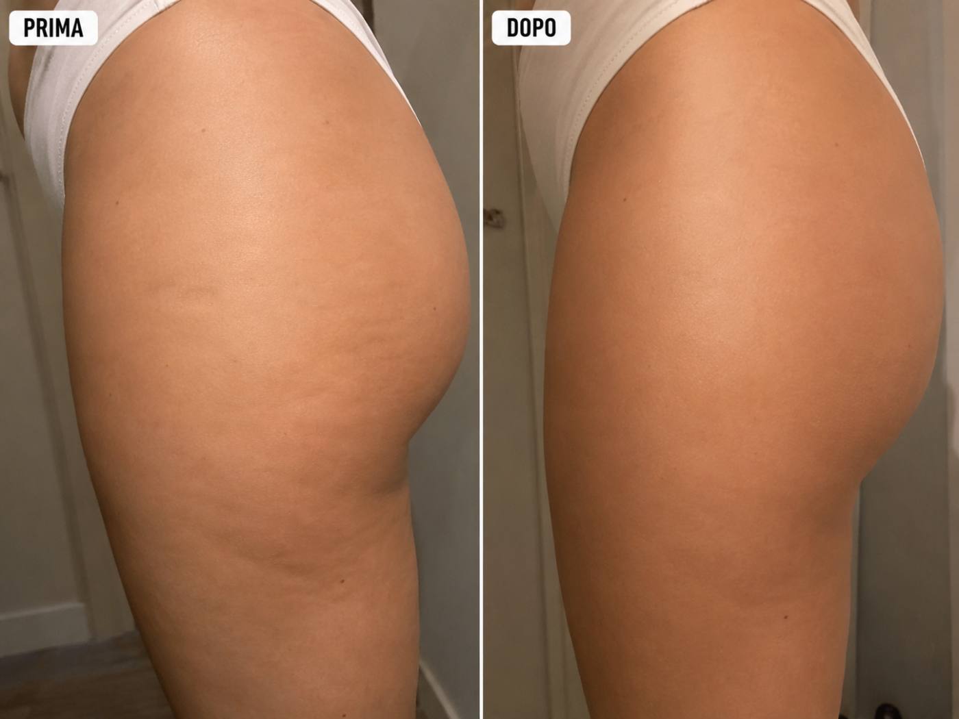 Prima e dopo Drenéa — cellulite e gambe gonfie