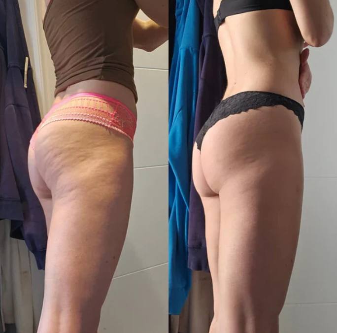 Prima e dopo Drenéa — cellulite e gambe gonfie