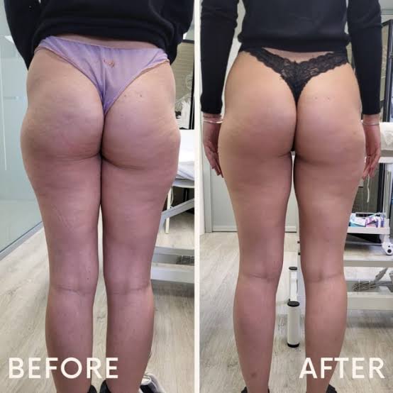 Prima e dopo Drenéa — cellulite e gambe gonfie