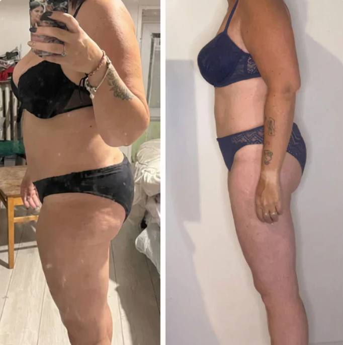 Prima e dopo Drenéa — cellulite e gambe gonfie