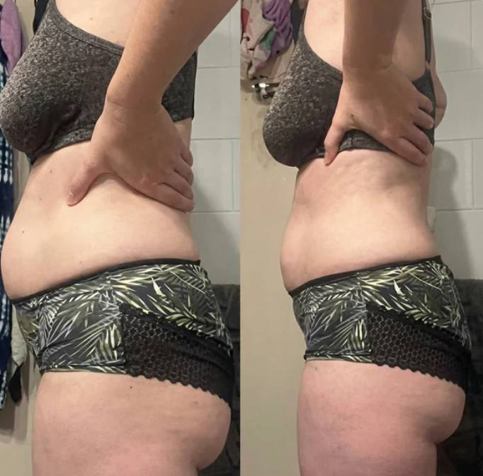 Prima e dopo Drenéa — cellulite e gambe gonfie