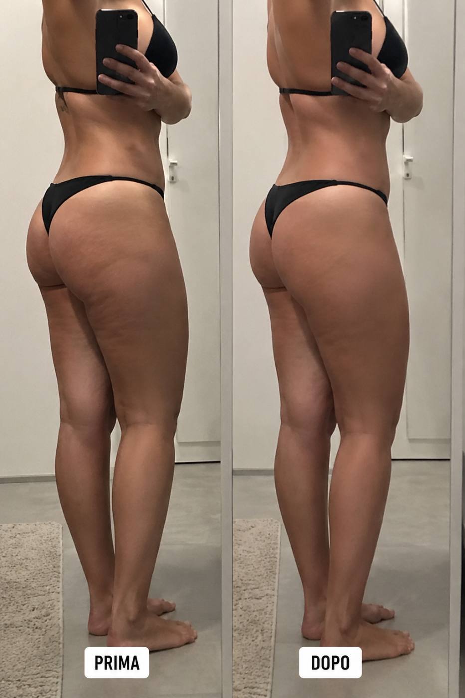 Prima e dopo Drenéa — cellulite e gambe gonfie