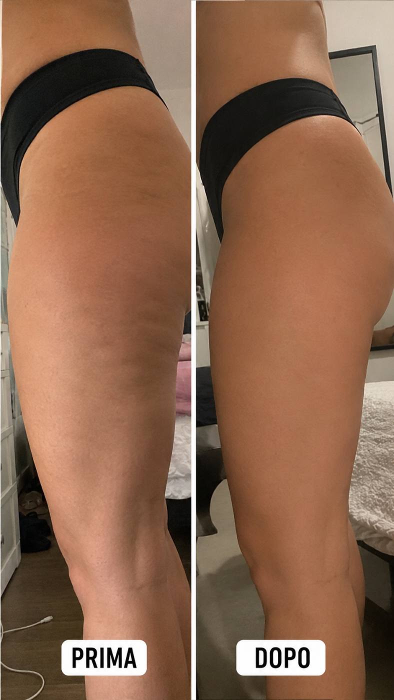 Prima e dopo Drenéa — cellulite e gambe gonfie