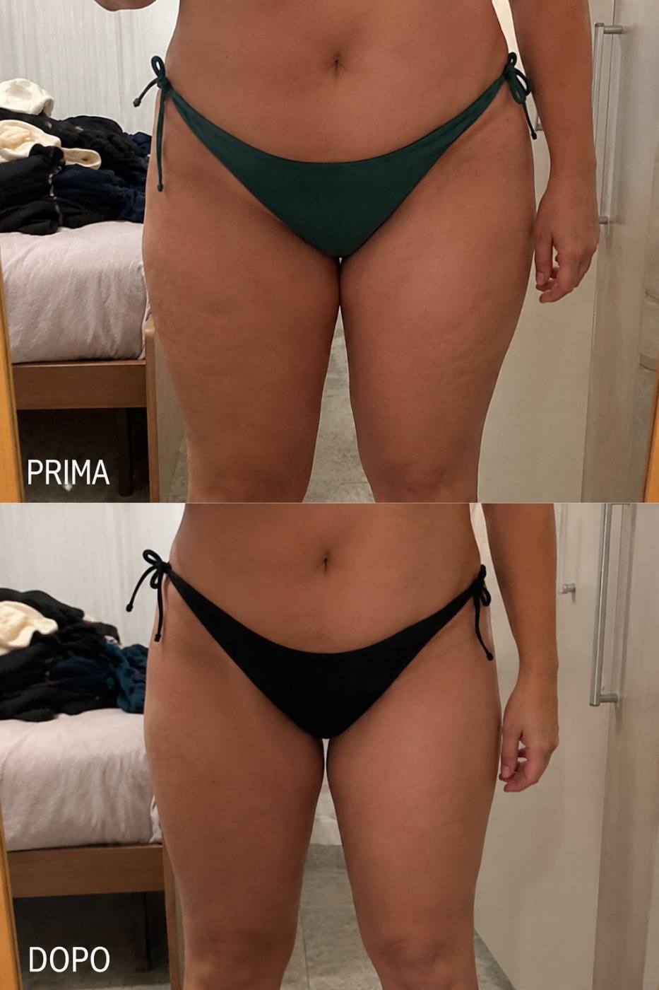 Prima e dopo Drenéa — cellulite e gambe gonfie