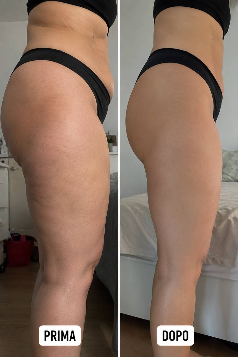 Prima e dopo Drenéa — cellulite e gambe gonfie