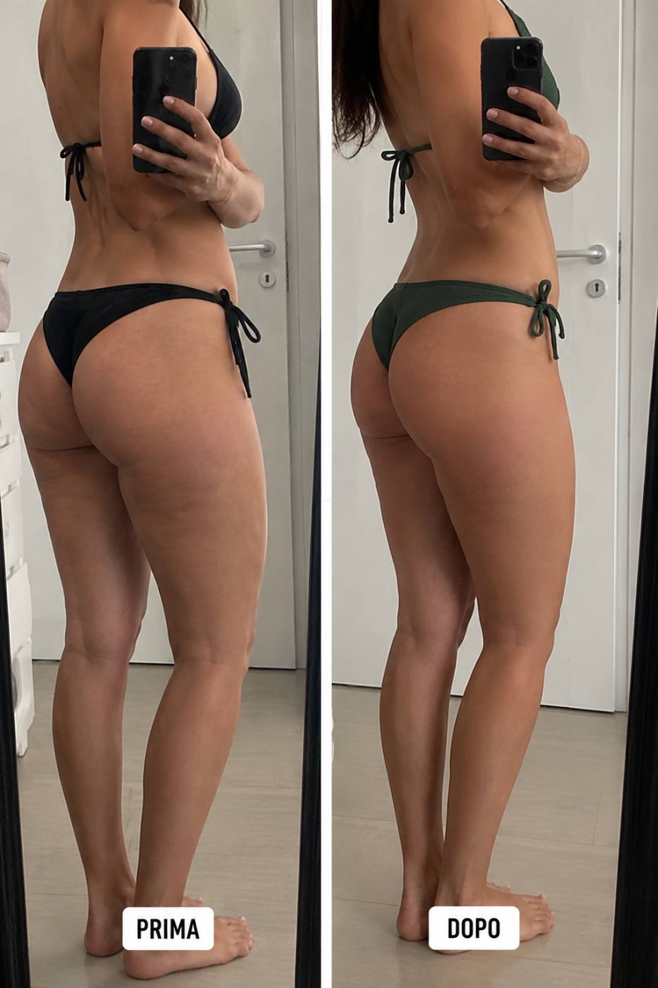 Prima e dopo Drenéa — cellulite e gambe gonfie