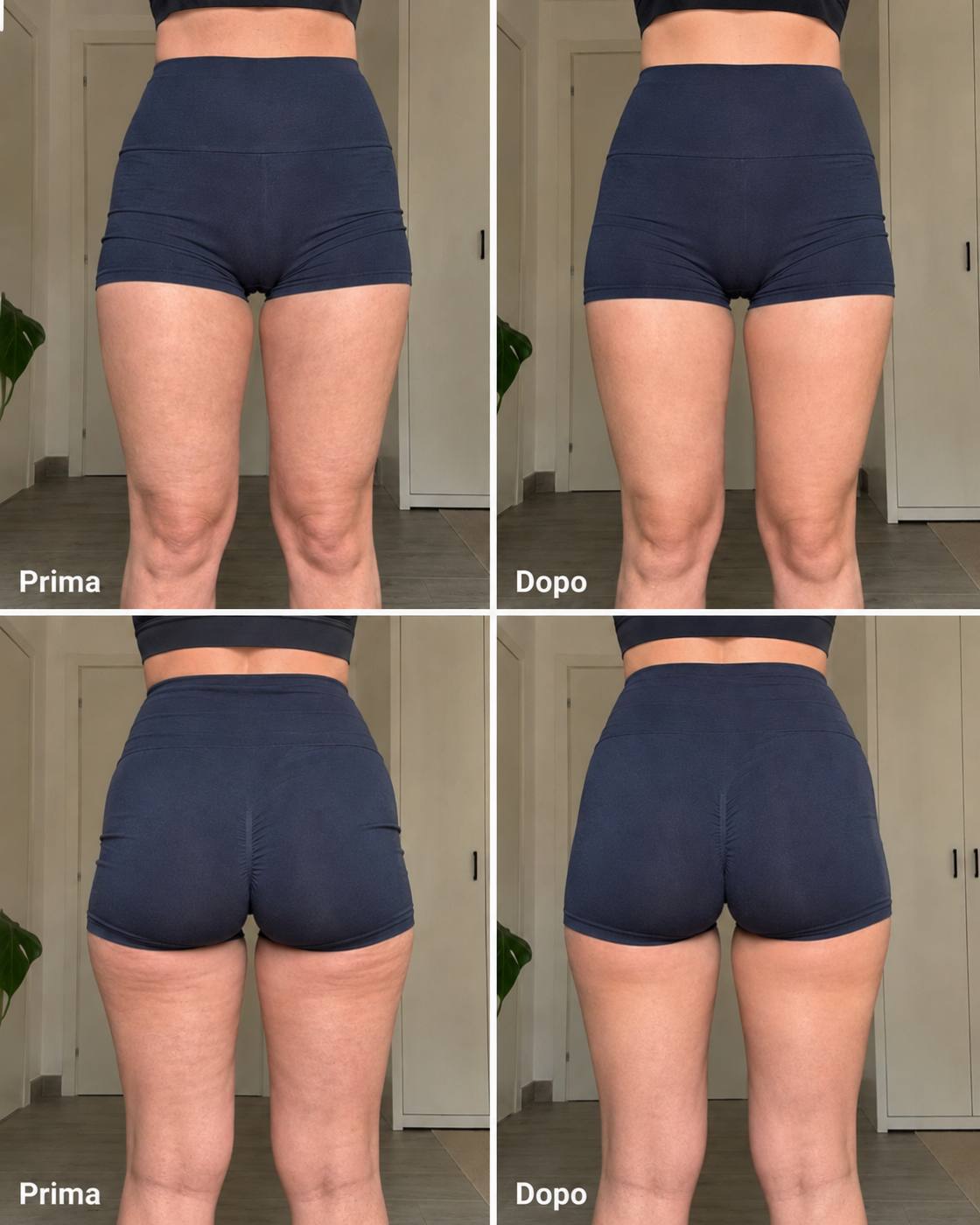 Prima e dopo Drenéa — cellulite e gambe gonfie