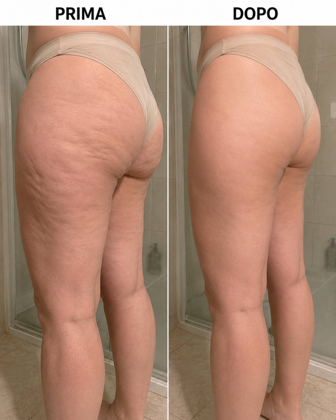 Prima e dopo Drenéa — cellulite e gambe gonfie
