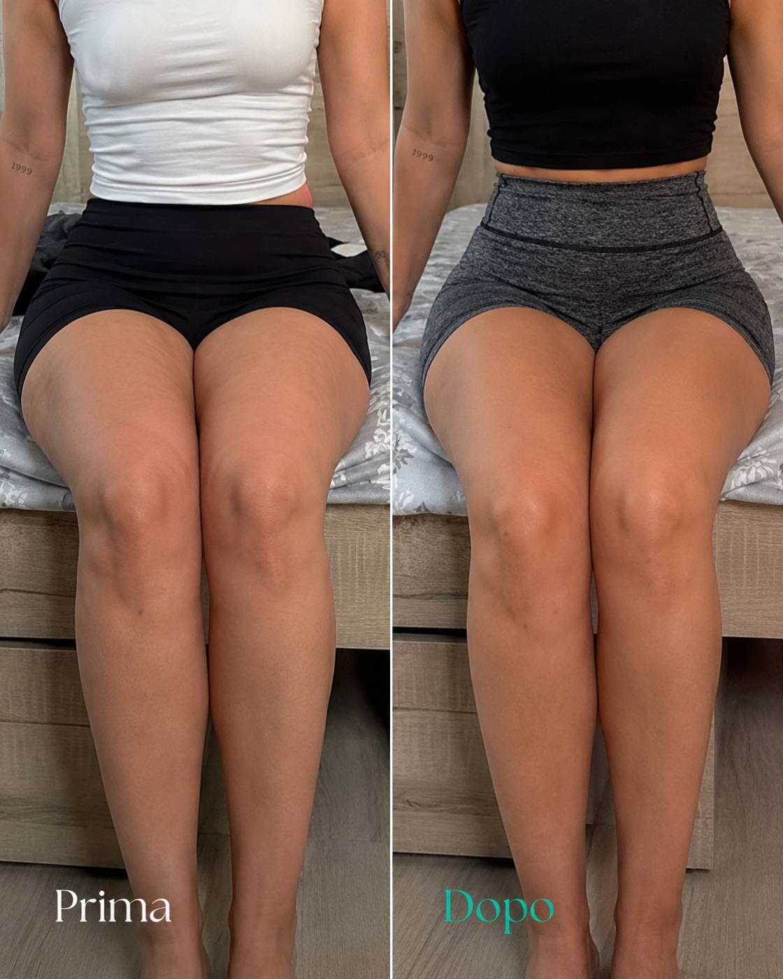 Prima e dopo Drenéa — cellulite e gambe gonfie