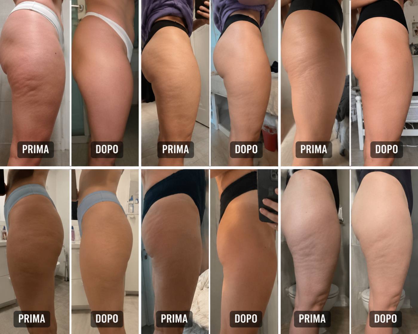 Prima e dopo Drenéa — cellulite e gambe gonfie