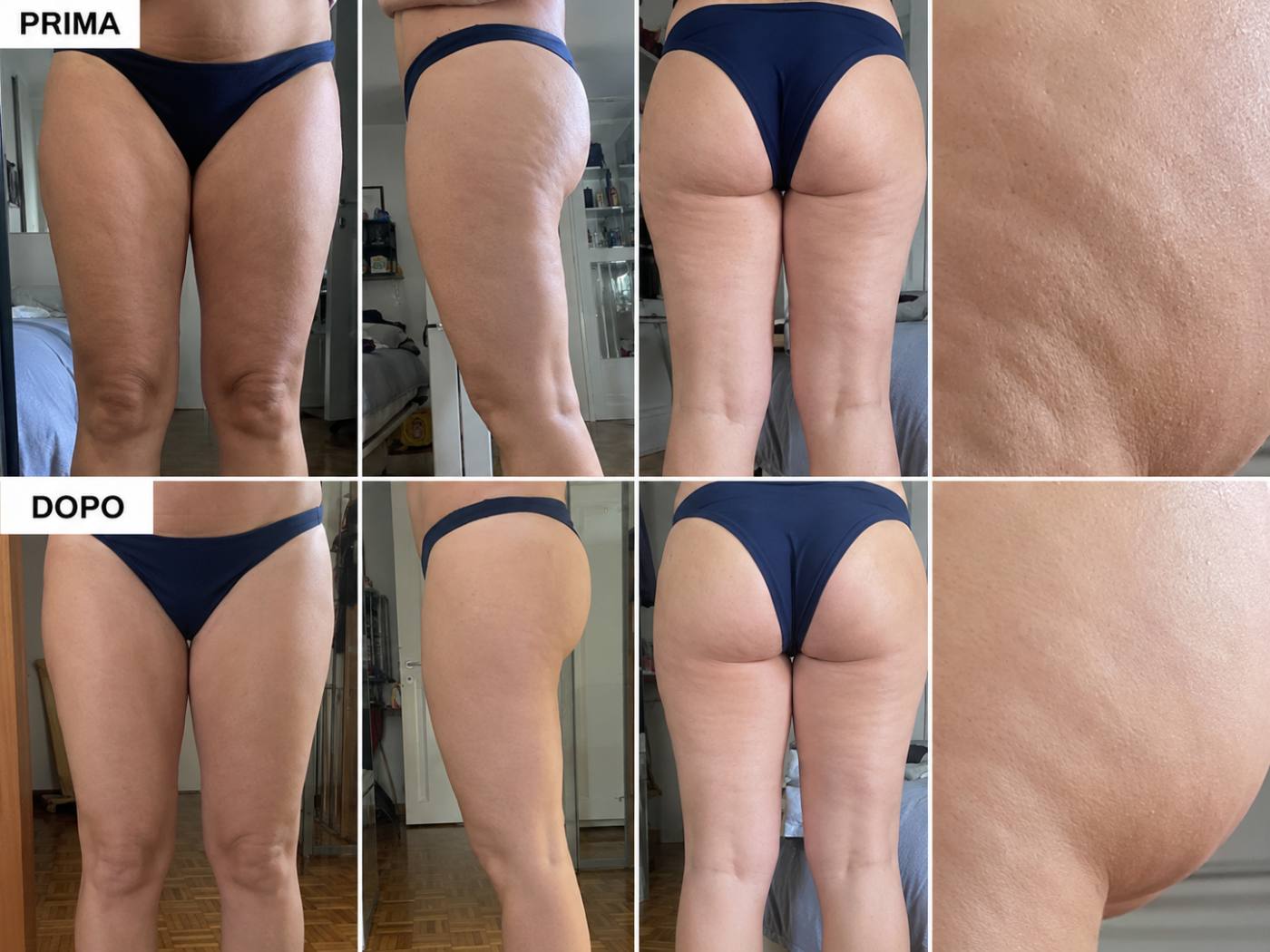 Prima e dopo Drenéa — cellulite e gambe gonfie