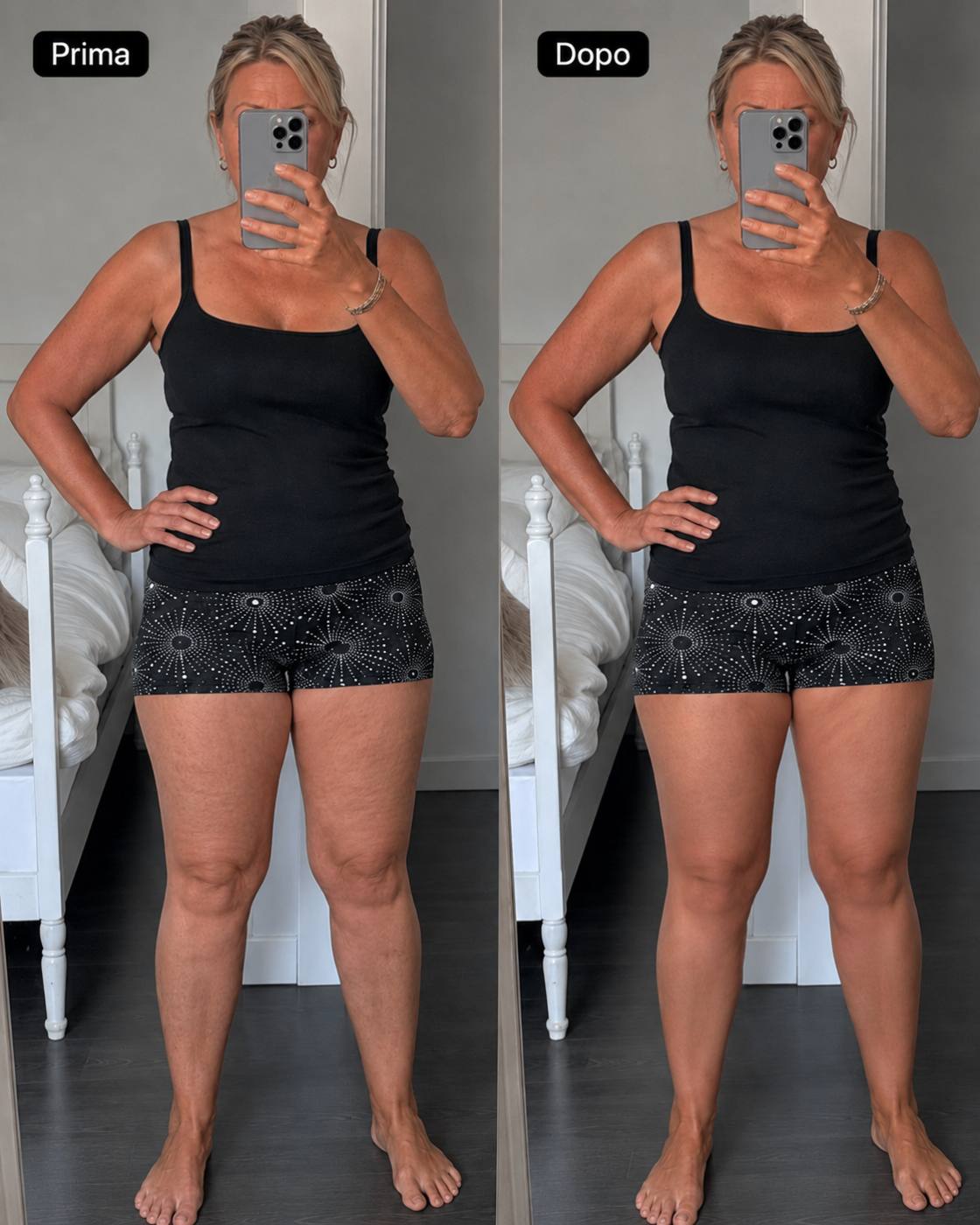 Prima e dopo Drenéa — cellulite e gambe gonfie