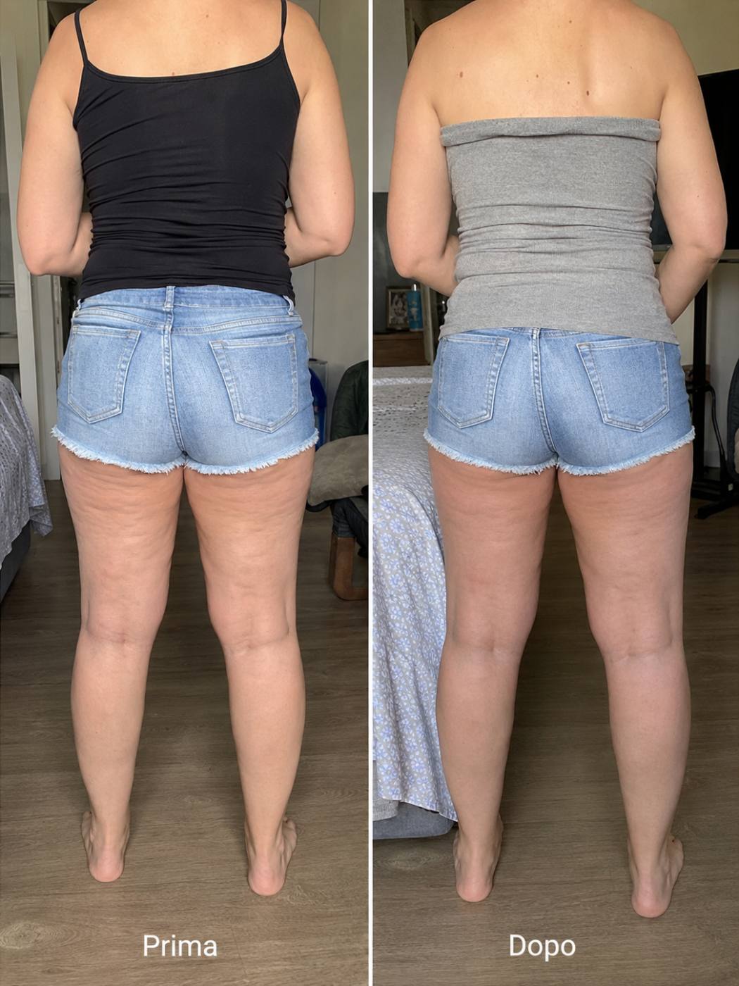 Prima e dopo Drenéa — cellulite e gambe gonfie