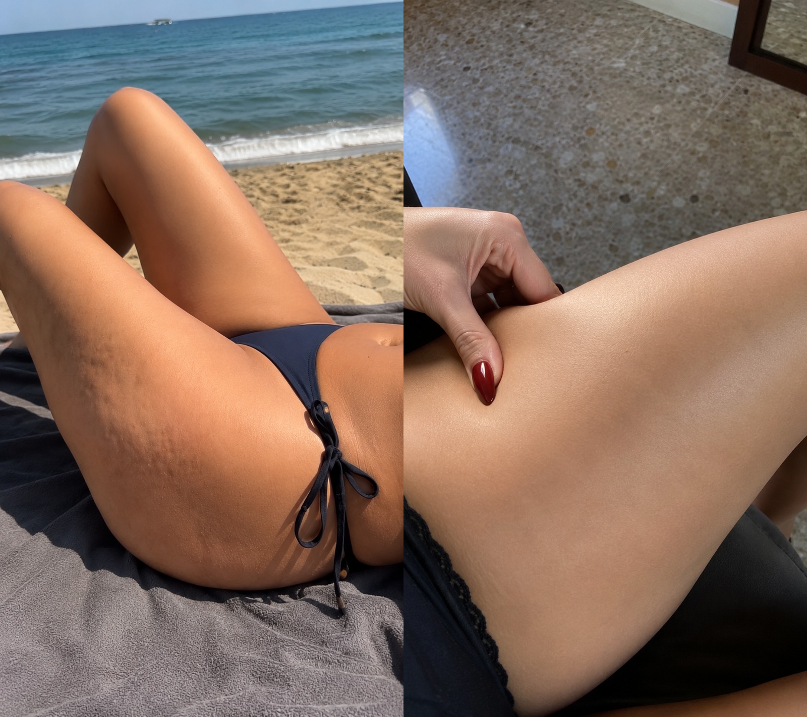 Prima e dopo Drenéa — cellulite e gambe gonfie